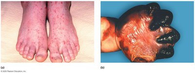 Petechiae in Meningococcal Septicemia
