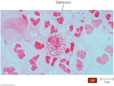 Gram-negative diplococci in pus