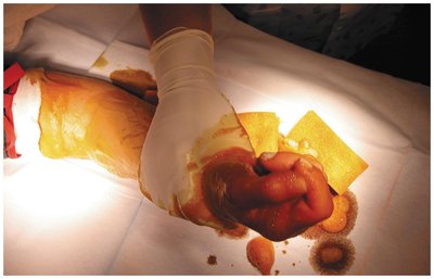 Degerming in preparation for surgery on a hand