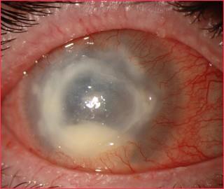 Acanthamoeba keratitis in the eye