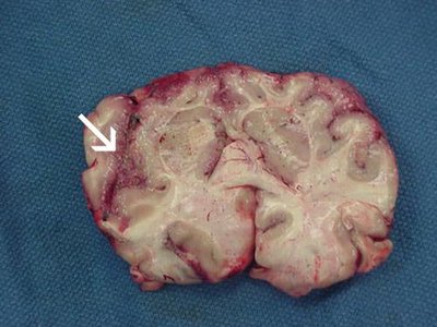 Brain tissue with amoebic infection