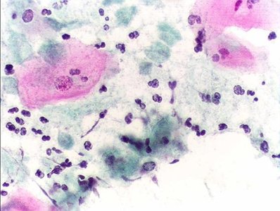 Trichomonas vaginalis in a clinical sample