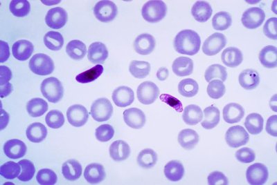 Plasmodium in red blood cells (malaria)