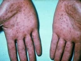 Borrelia burgdorferi (Lyme disease)