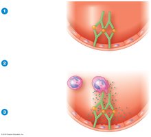 Immune complex-mediated hypersensitivity