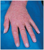 Contact dermatitis: skin rash and blistering