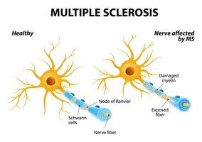 Multiple sclerosis: healthy vs. affected nerve