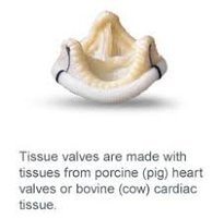 Porcine heart valve for transplantation