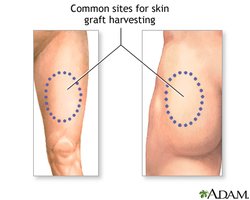 Common sites for skin graft harvesting