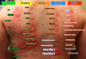 Allergy skin test results