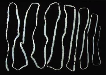 Guinea worm infection