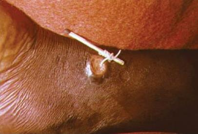 Medical symbol with worm