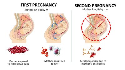 Hemolytic Disease of the Newborn: First and Second Pregnancy