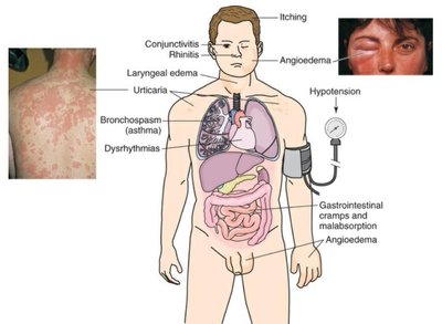 Type I, IgE-Mediated Hypersensitivity Reactions (Manifestations)