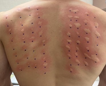 Skin prick allergy test on back
