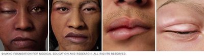 Examples of angioedema