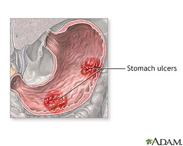 Stomach ulcers and Nobel Prize winners Marshall and Warren