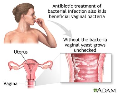 Diagram showing primary bacterial infection and secondary yeast infection