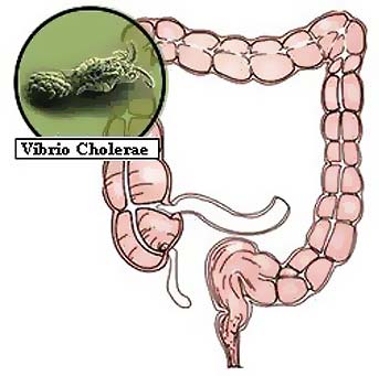 Vibrio cholerae infection in the intestine