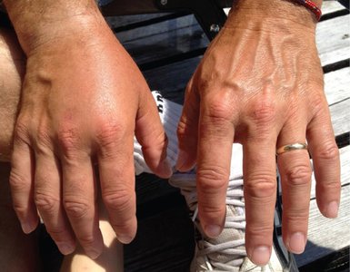 Clinical image of septic shock (swollen hands)