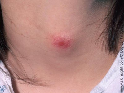 Image of a localized skin infection (boil)