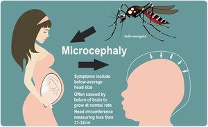 Microcephaly caused by Zika virus