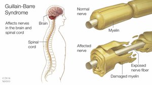 Guillain-Barré Syndrome diagram