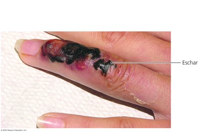 Cutaneous anthrax with eschar on a finger