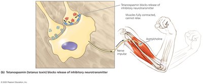 Tetanospasmin blocks inhibitory neurotransmitter, causing muscle contraction