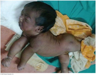 Clinical presentation of tetanus in a child (opisthotonos)