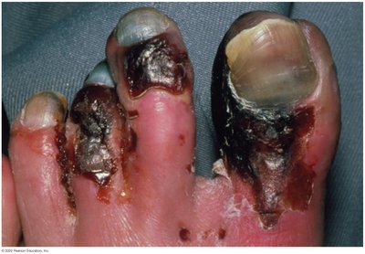 Gas gangrene affecting toes, showing tissue necrosis