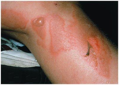 Scalded skin syndrome with large bullae