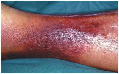 Erysipelas on lower leg