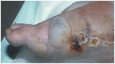 Necrotizing fasciitis with tissue destruction