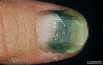 Pseudomonas infection under fingernail