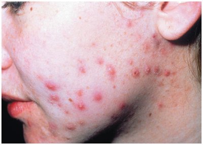 Acne lesions on the face
