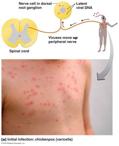 Shingles recurrence along a nerve