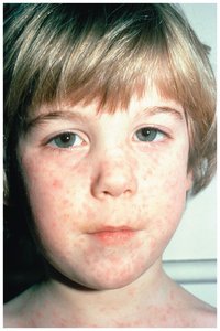 Measles rash on a child's face