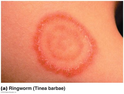Ringworm (tinea barbae) lesion