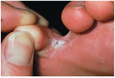 Athlete's foot (tinea pedis) between toes