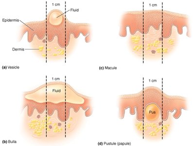 Diagram of vesicle, bullae, macule, and pustule skin lesions