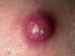 Furuncle (boil) on skin