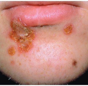 Impetigo lesions around the mouth