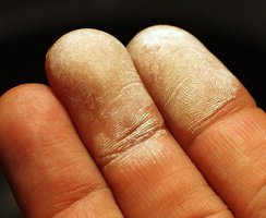 Fingertips after hydrogen peroxide exposure