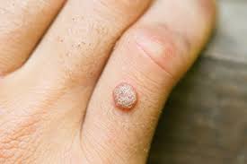 Skin infection example