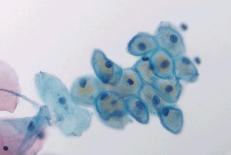 Superficial and intermediate squamous cells