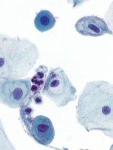 Lymphocytes and histiocytes