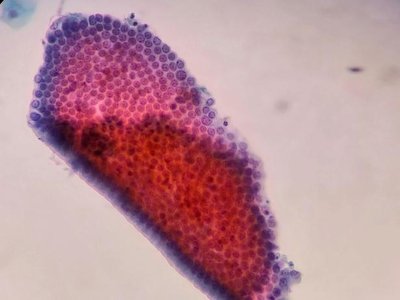 Polymorphonuclear leukocytes