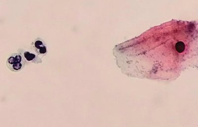 Lymphocytes and plasma cells
