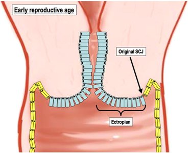 Early reproductive age cervix: SCJ and ectropion